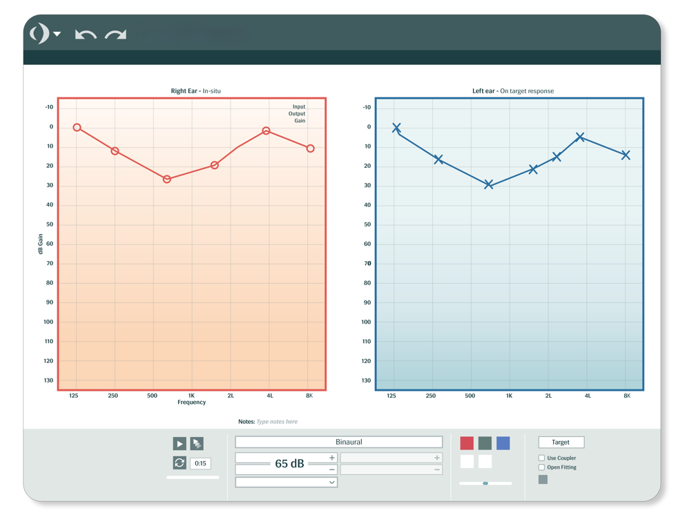 Cookie bite hearing loss audiogram example showing mid-frequency dip